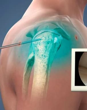 Shoulder arthroscopy specialist in South Delhi operating theatre