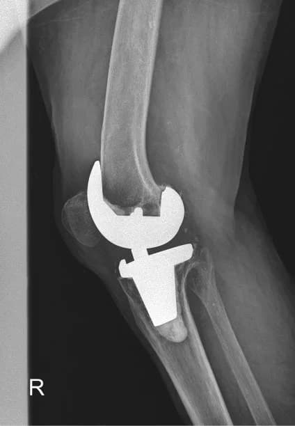 Patient completing hip rehab exercises
