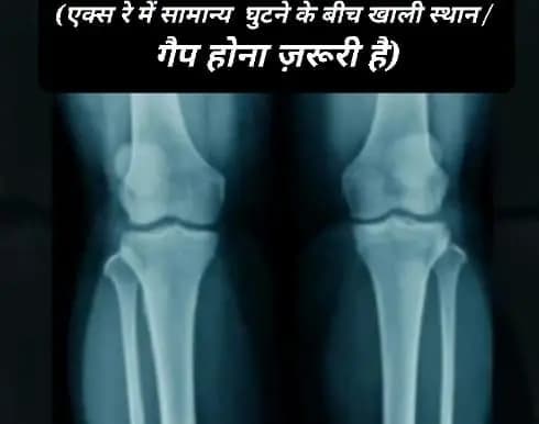 Follow-up radiograph showing knee joint recovery at South Delhi clinic