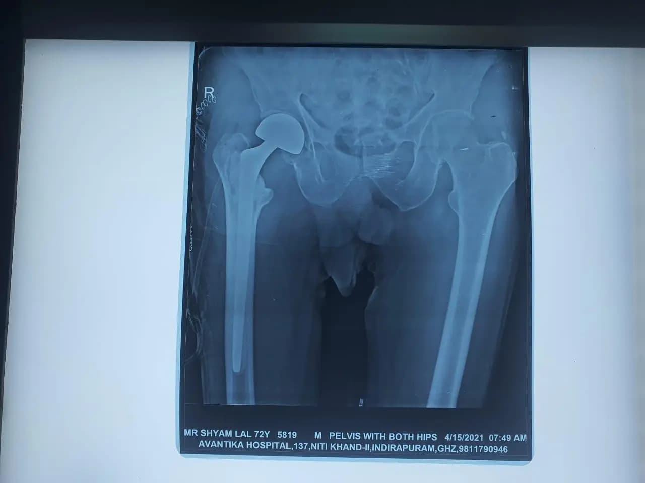 Hip hemiarthroplasty surgical outcome